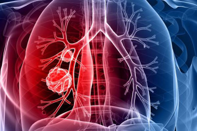 A tüdőrák molekuláris diagnosztikája és célzott kezelése